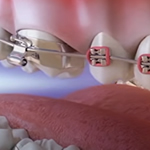 Ortodoncia y braces dentales en Houston, Texas