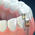 Implantes dentales en Houston, Texas